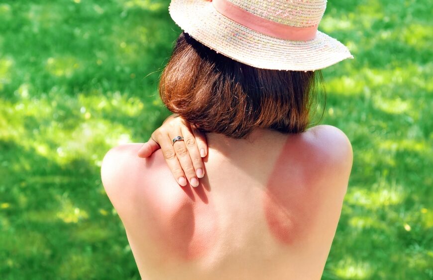 Tips for Staying Safe from the Sun, Naturally